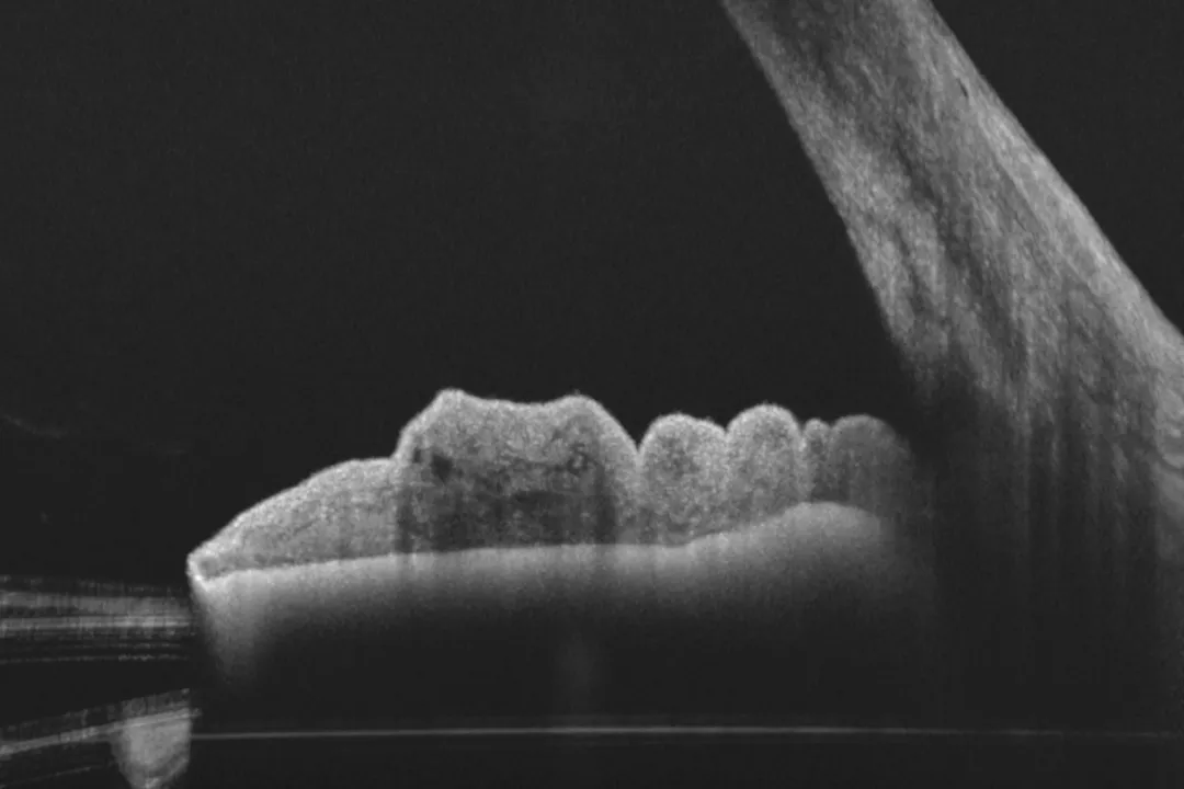 OCT de segmento anterior en patología de Iris