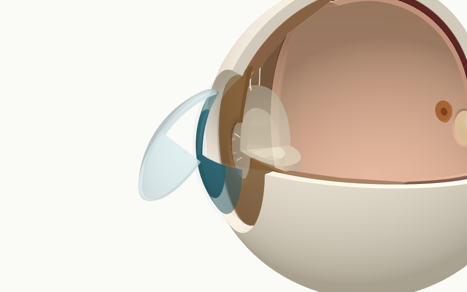 Modelo 3D del ojo mostrando el colgajo LASIK y el tratamiento del estroma
