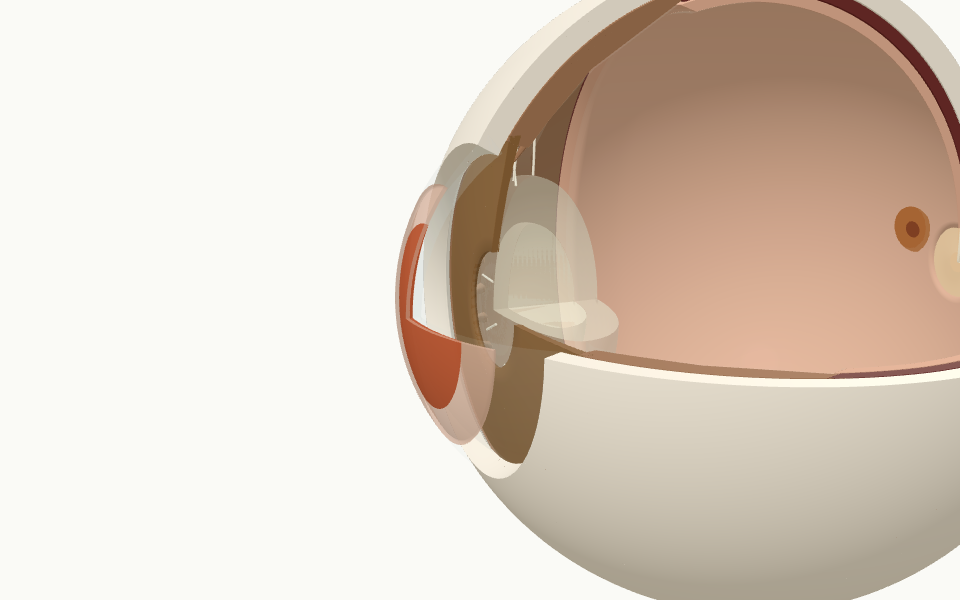 Modelo 3D del ojo mostrando el tratamiento láser en la superficie de la córnea